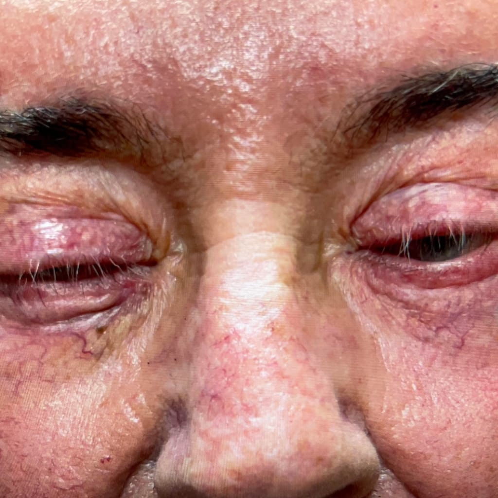 after multiple eyelid surgeries an inability to close eyes completely
