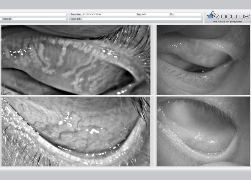 Dr. Edward Boshnick Dry Eye Syndrome & Scleral Lenses