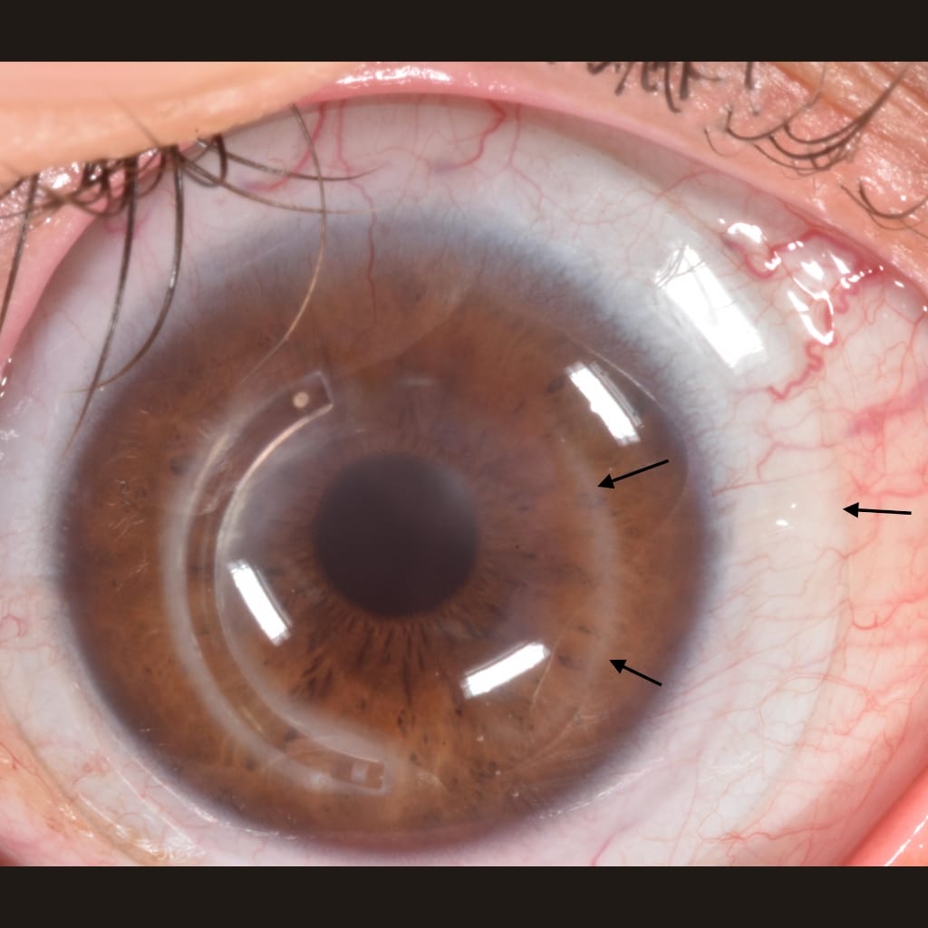 post surgical vision loss- INTACS surgery complications