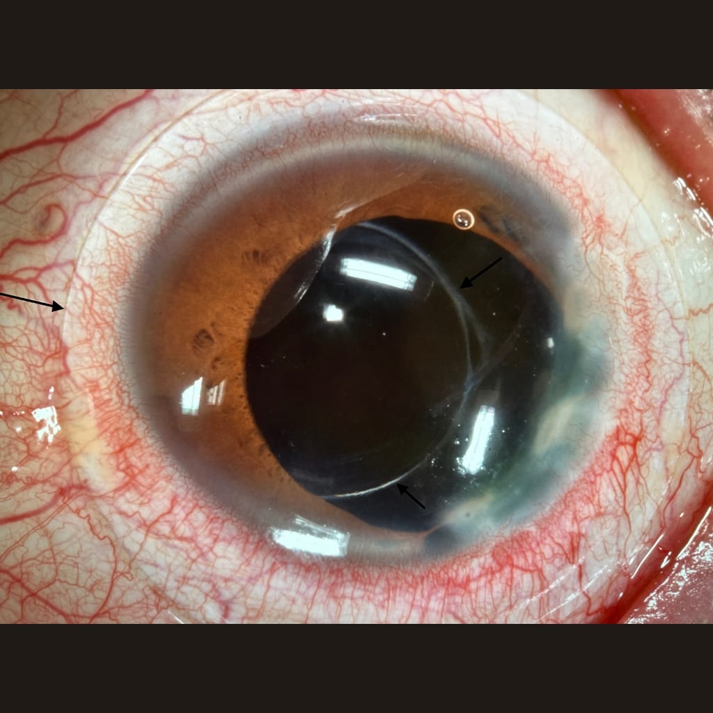 torn iris and distorted pupil due to ocular trauma