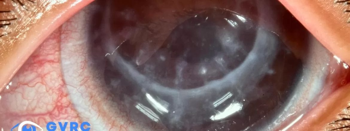 Fuchs Corneal Dystrophy