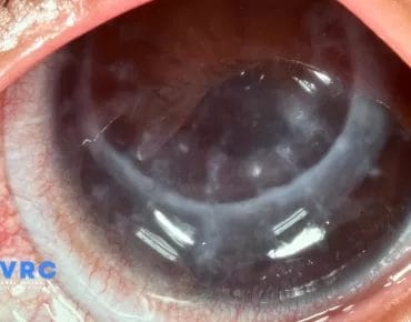 Fuchs Corneal Dystrophy