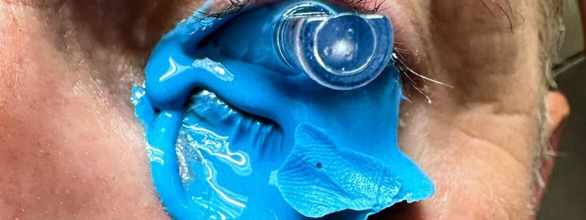 Person applying a scleral lens to manage keratoconus symptoms