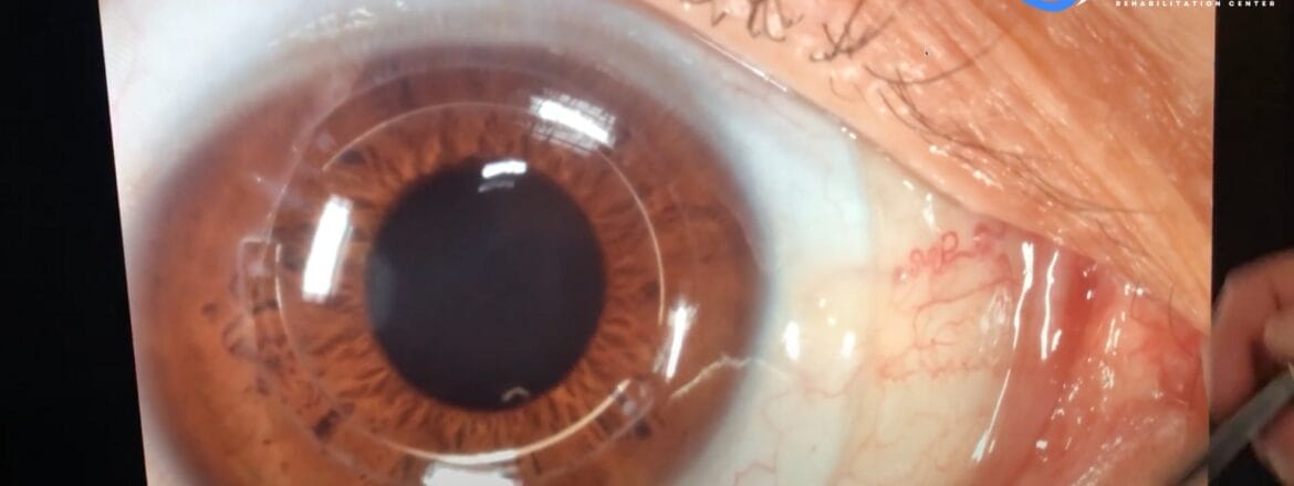 Dr. Edward Boshnick demonstrating the use of a scleral lens
