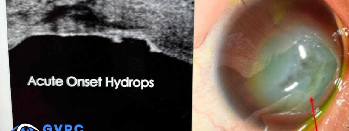 Doctor Examining Patient's Eye for Keratoconus