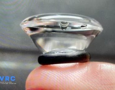 Scleral Lens Dry Eye Syndrome