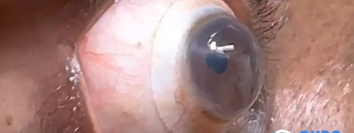 Scleral lenses for keratoconus treatment