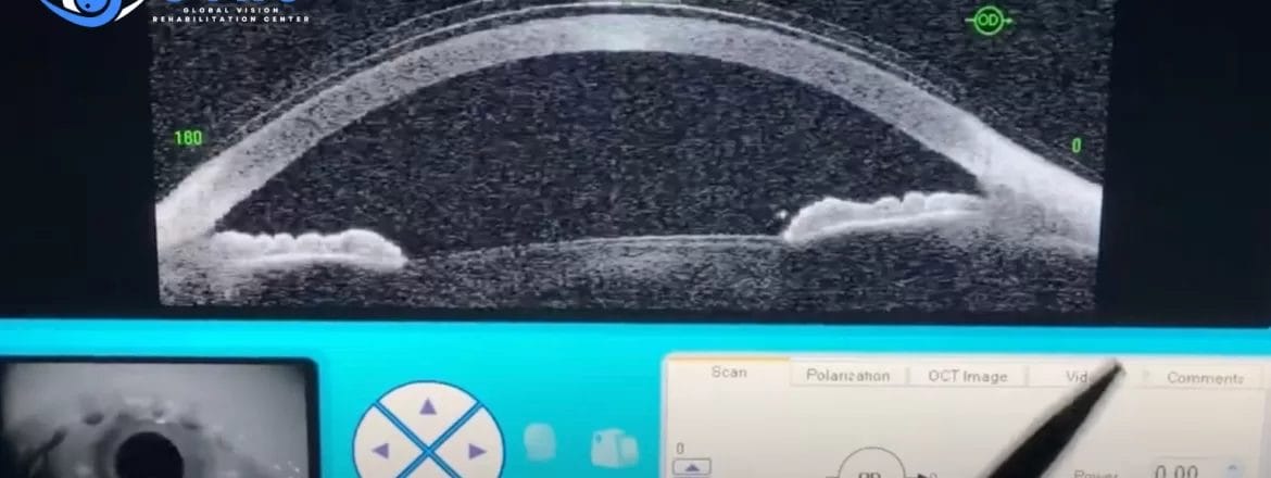 Person applying scleral lenses for dry eye