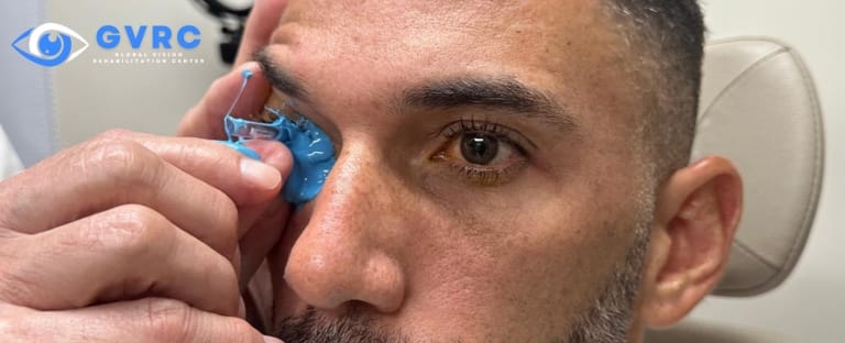 Doctor fitting a keratoconus patient with scleral lenses