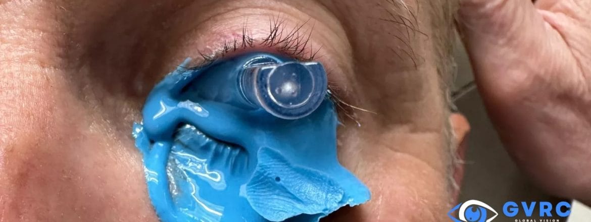 Global Vision Rehabilitation Center - Advanced Keratoconus Treatment with EyePrint Pro and Scleral Lenses