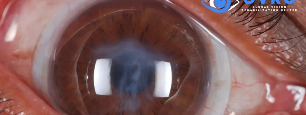 Scleral_Lenses_for_Keratoconus_Treatment