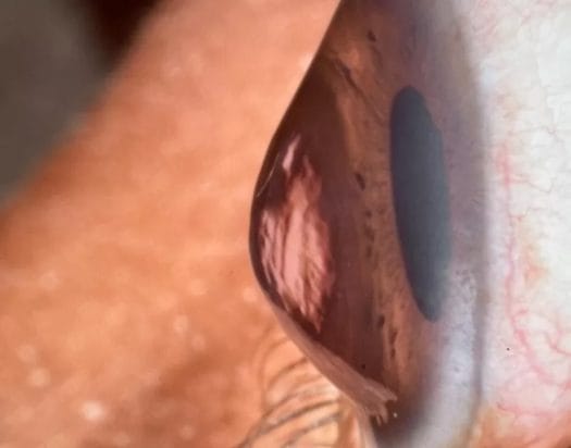 Scleral Lens over eye with keratoconus