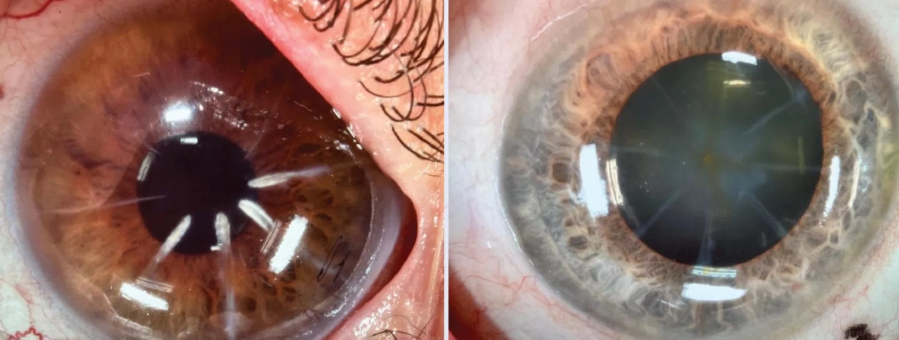 Scleral lenses over eyes.