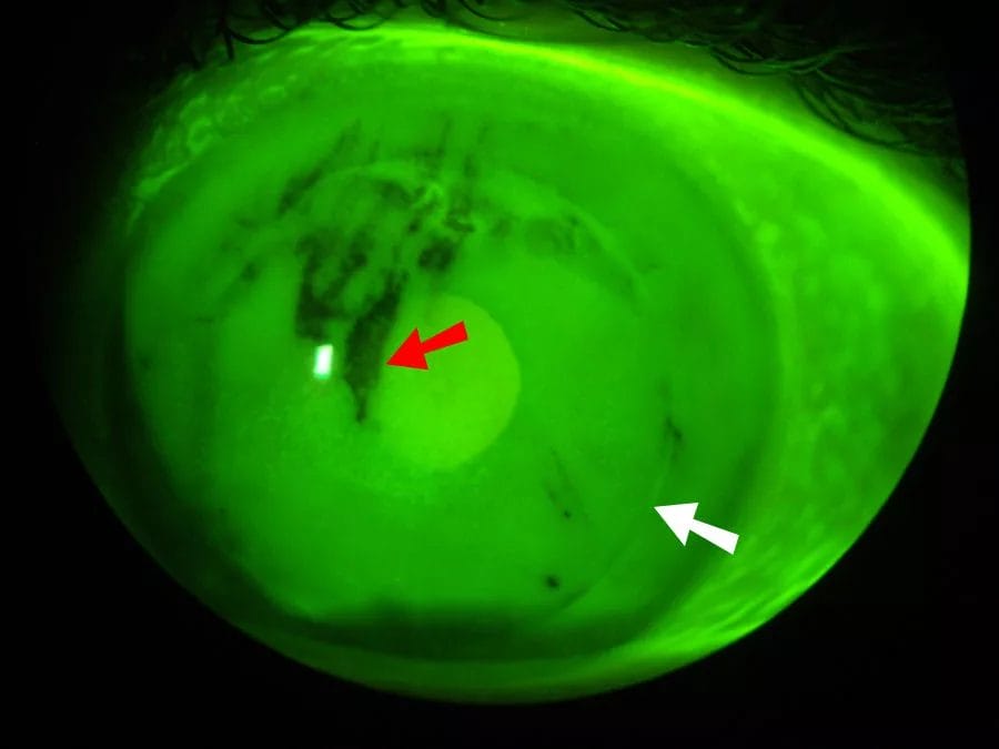 Dry Eye Syndrome