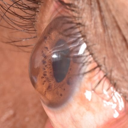 Keratoconus-Conditions-GVRC-2