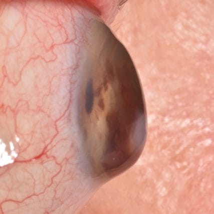 Keratoconus-Conditions-GVRC-3