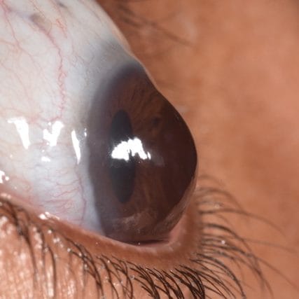 Keratoconus-Conditions-GVRC-4