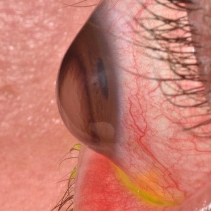 Keratoconus-Conditions-GVRC