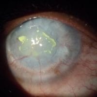 corneal-disease-rehabilitation-specialty-lenses-inflammation-and-ocular-surface-diseases-2