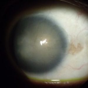 corneal-disease-rehabilitation-specialty-lenses-inflammation-and-ocular-surface-diseases-22