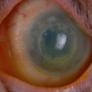 corneal-disease-rehabilitation-specialty-lenses-inflammation-and-ocular-surface-diseases-23