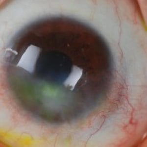 corneal-ectasia-treatments-2