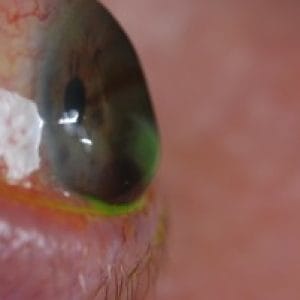 corneal-ectasia-treatments-4