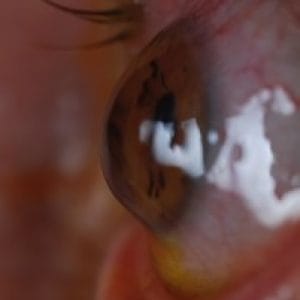 corneal-ectasia-treatments-5