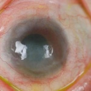 corneal-ectasia-treatments-6
